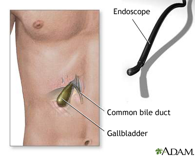 Gallbladder endoscopy