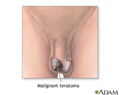 Malignant teratoma