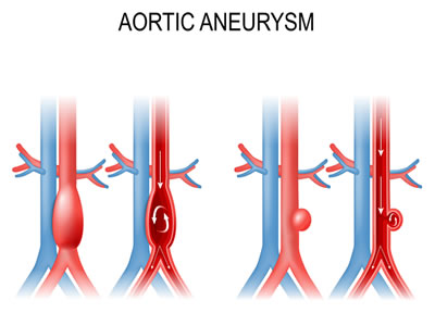 Illustrations of typical abdominal aorta and of aortic aneurysm