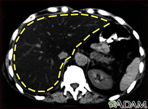 Liver fattening, CT scan