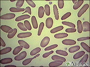 Red blood cells, elliptocytosis