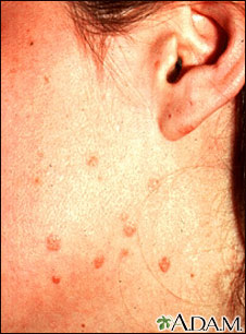 Warts, flat on the cheek and neck
