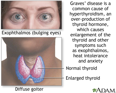 Graves' disease