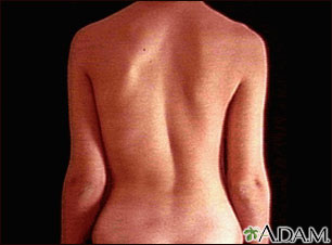 Scoliosis Bracing - Seattle, WA - Brain and Spine Surgery
