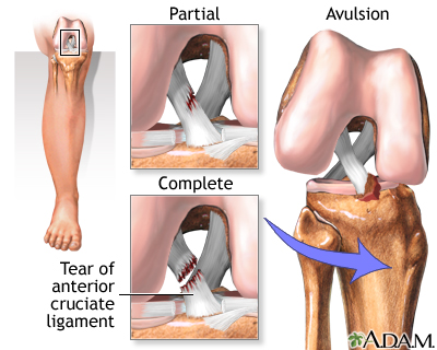 Anterior Cruciate Ligament Injury (ACL) - Symptoms and Causes