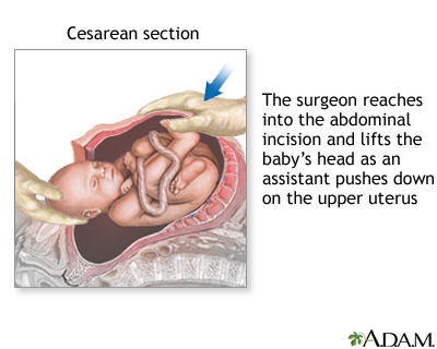 Cesearian Delivery : An essential guide