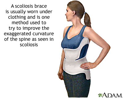 Scoliosis Bracing - Seattle, WA - Brain and Spine Surgery